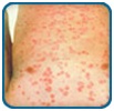 psoriasis-2